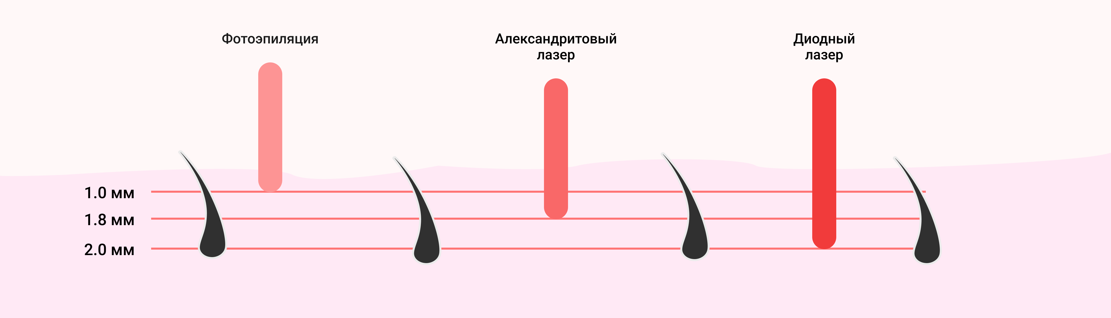 Преимущества диодного лазера